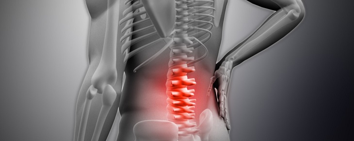 Người bệnh có thể gặp phải triệu chứng đau lưng dữ dội