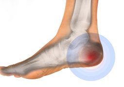 đau khớp gót chân