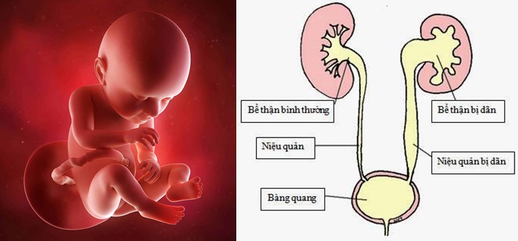 Bể thận ứ nước có thể xảy ra ở cả thai nhi đang trong bụng mẹ