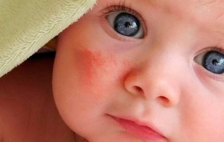 Chàm đỏ ở trẻ sơ sinh là một tình trạng khá phổ biến