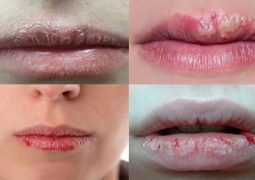 Bệnh chàm môi là gì và có những loại chàm môi nào bạn cần lưu ý?