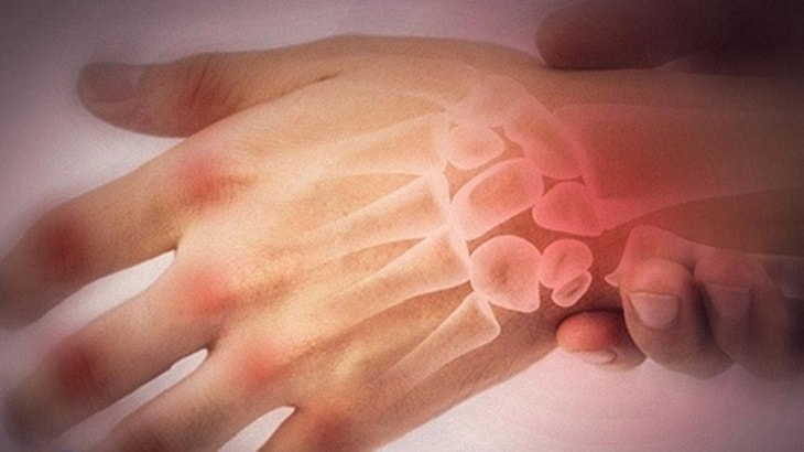 Viêm khớp nhiễm khuẩn cũng có thể là nguyên nhân gây đau khớp ngón tay sau sinh