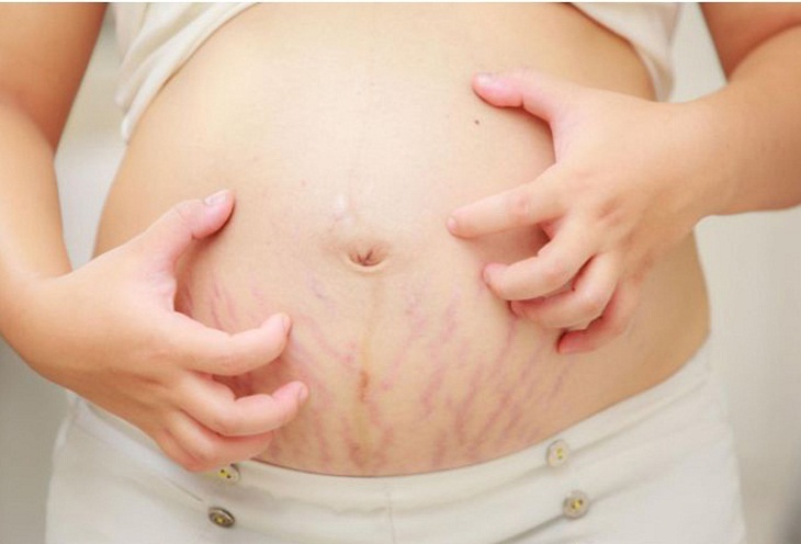 Sự căng rạn da có thể là nguyên nhân gây nổi mề đay khi mang thai 3 tháng đầu