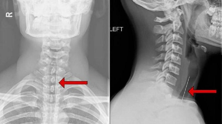 Chụp X-quang trên thực tế có khả năng phát hiện bệnh lý thoát vị đĩa đệm