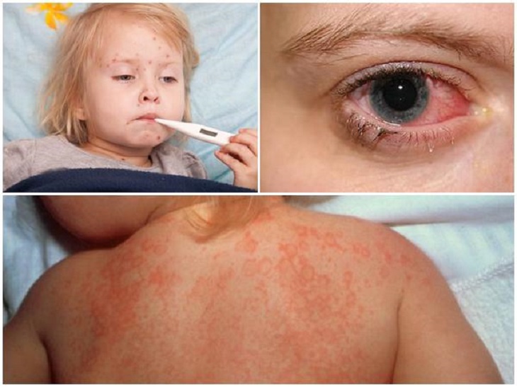 Một số triệu chứng sốt siêu vi thường gặp nhất là phát ban, sốt cao hay chảy nước mắt
