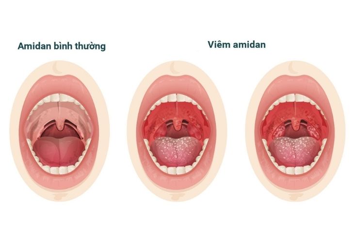 Viêm amidan là một bệnh lý mũi họng thường gặp