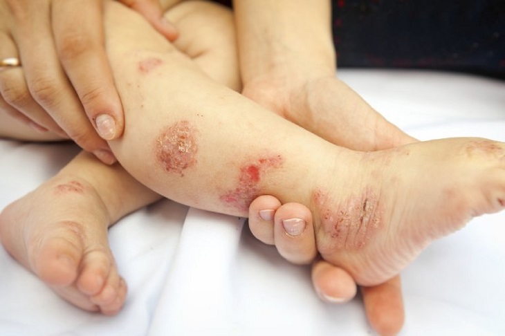 Tình trạng bội nhiễm trên da còn có thể khởi phát khi gặp một số điều kiện thuận lợi