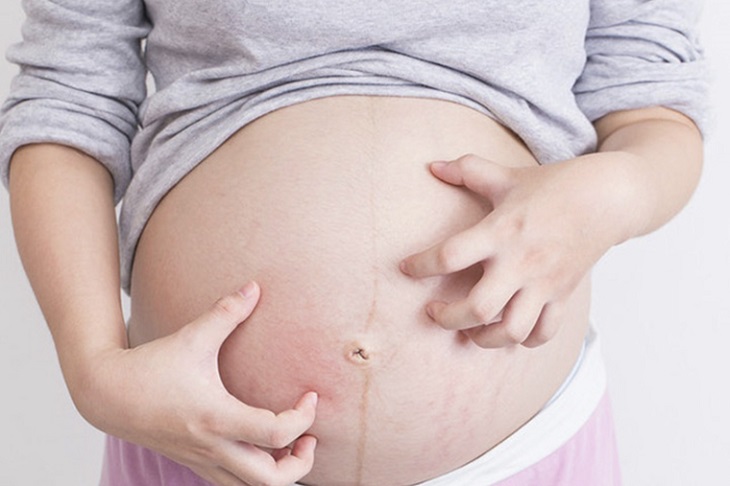 Viêm da cơ địa khi mang thai không xử lý kịp thời sẽ gây biến chứng nguy hiểm