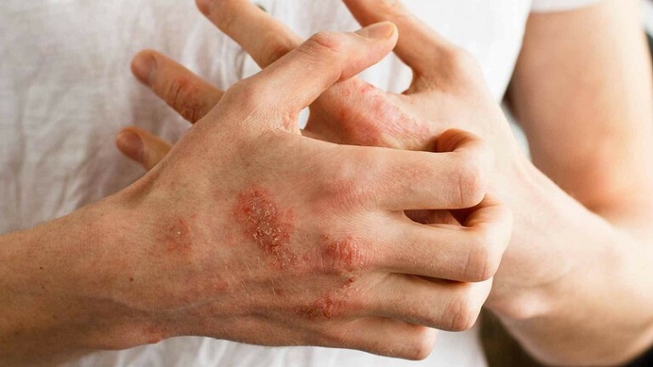 Viêm da cơ địa ở tay là bệnh gì và triệu chứng thường gặp