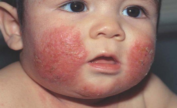Trẻ bị viêm da trên mặt sẽ có những mảng đỏ xuất hiện 