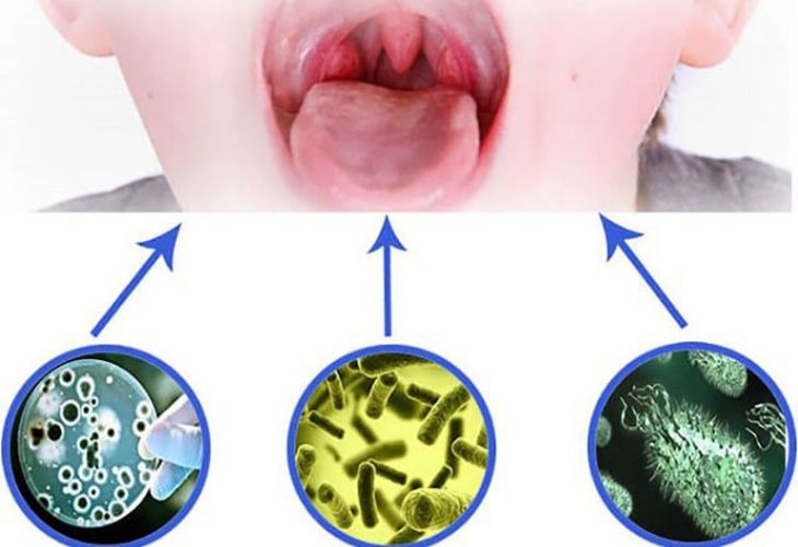 Virus, vi khuẩn là nguyên nhân chính gây bệnh viêm mũi họng cấp tính