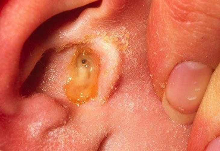 Viêm tai giữa là một bệnh lý vô cùng nguy hiểm và dễ khởi phát