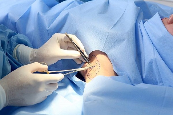 Phương pháp cắt hạch giao cảm ở một số bệnh nhân