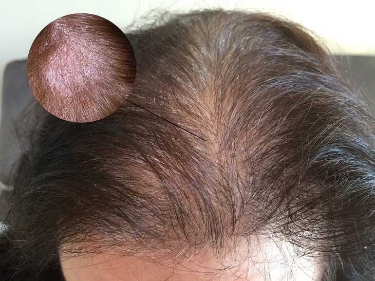 Á sừng da đầu là bệnh mãn tính khó điều trị khỏi hoàn toàn