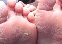 Bệnh á sừng ở chân có thể tái phát khi gặp điều kiện thích hợp