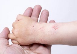 Bệnh á sừng ở trẻ em thường có tính chất kéo dài dai dẳng, khó điều trị khỏi