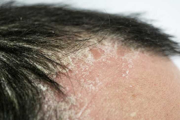 Vảy nến da đầu có thể phát sinh biến chứng trong thời gian ngắn