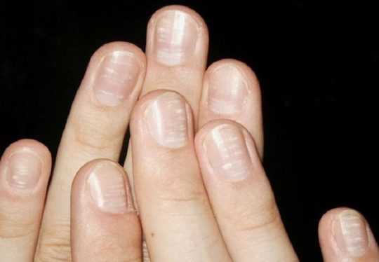Vảy nến móng tay  là bệnh da liễu phổ biến bất kỳ ai cũng có thể bị
