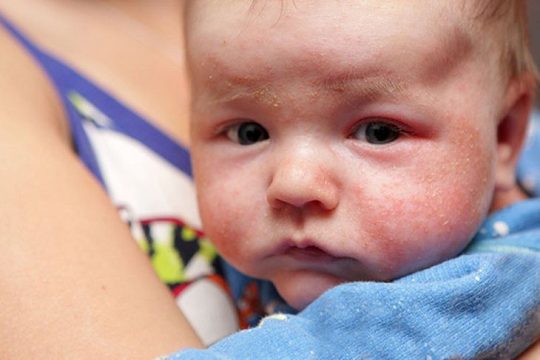 Bệnh vảy nến ở trẻ sơ sinh nếu không điều trị có thể gây nhiều biến chứng nguy hiểm
