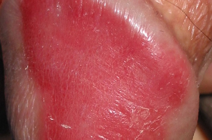 Vùng da bị vảy nến thường bị khô sần, có màu đỏ tươi và vảy trắng bong tróc