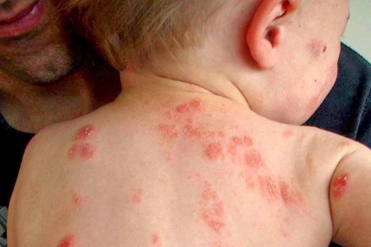 Vảy nến ở trẻ em có thể gây biến chứng nhiễm trùng da