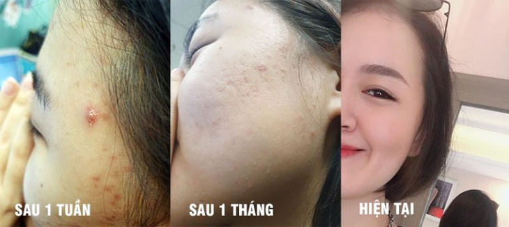 Hình ảnh làn da của khách hàng trước và sau khi điều trị mụn với liệu trình thảo dược Nhất Nam Hoàn Nguyên Bì