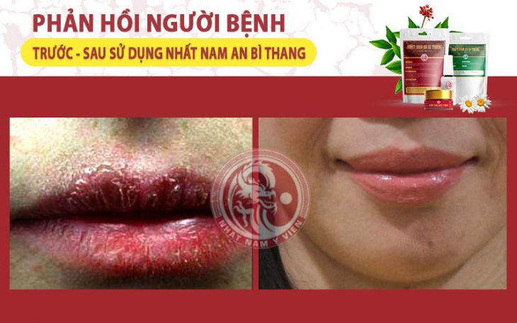 Tình trạng chàm môi của chị Minh Loan đã giảm đáng kể