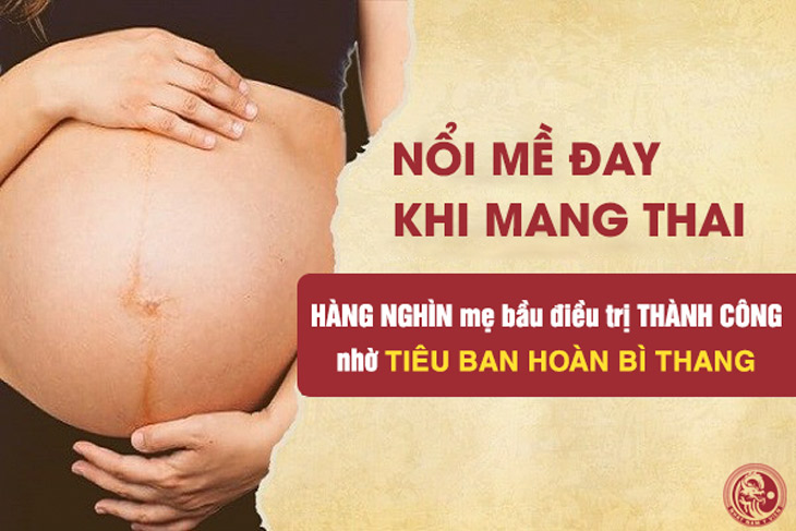 Tiêu Ban Hoàn Bì Thang được nhiều mẹ bầu lựa chọn để chữa mề đay khi mang thai
