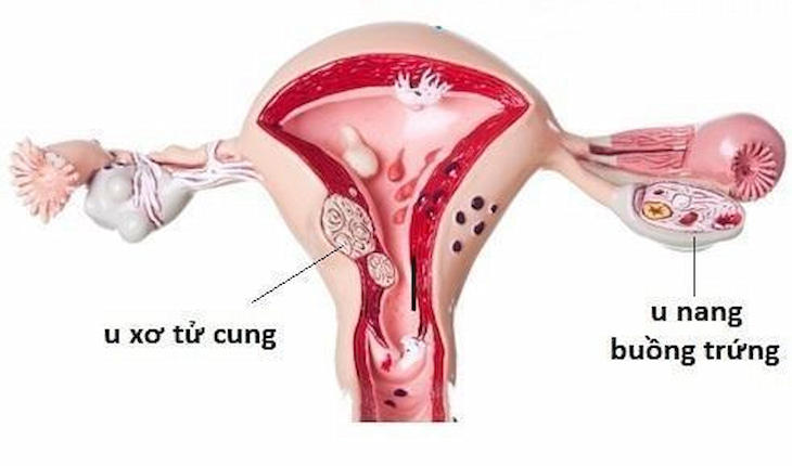 Phân biệt u xơ tử cung và u nang buồng trứng để có phương pháp điều trị phù hợp