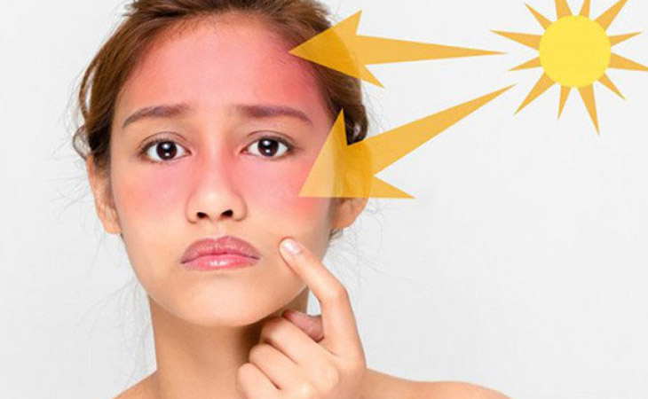 Tia UV-B là một trong số những nguyên nhân gây ra tình trạng tàn nhang