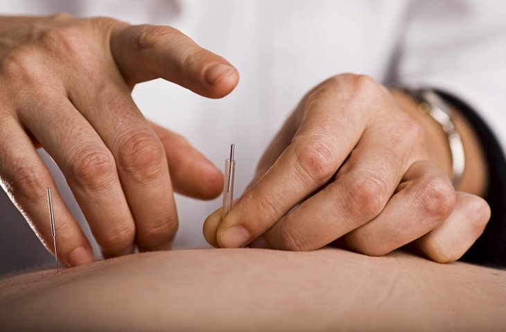 Lựa chọn bấm huyệt và châm cứu có thể hỗ trợ trong quá trình điều trị hội chứng ống cổ tay