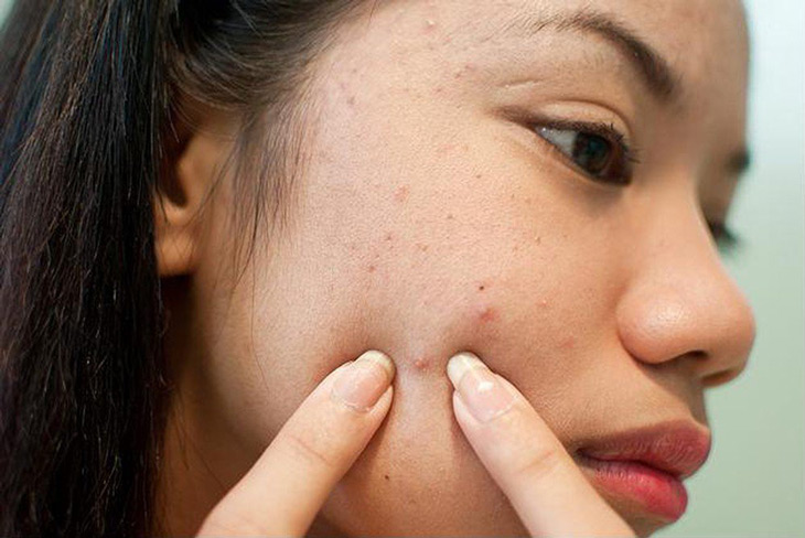 Nặn mụn không đúng cách sẽ gây nên những tổn thương cho làn da
