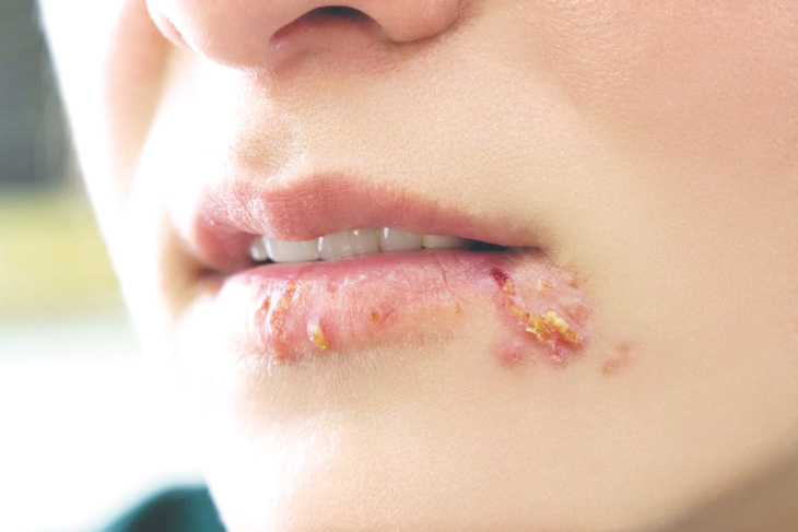 Mụn rộp thường xuất hiện ở trên môi và quanh miệng