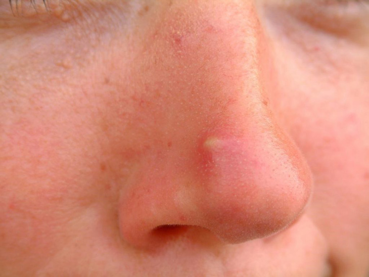Mụn bọc ở mũi là tình trạng viêm da thường gặp