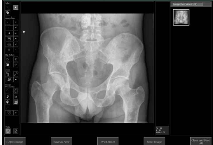 Hình ảnh tia X-quang giúp bác sĩ chẩn đoán tình trạng vôi hóa