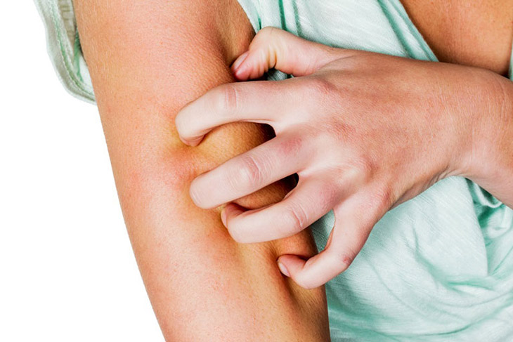 Cào gãi có thể làm tăng mức độ tổn thương của da