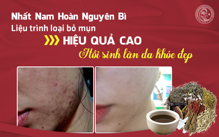 Làn da của bạn Lê Phương Thùy trước và sau khi điều trị mụn tại Trung tâm Da liễu Đông y Việt Nam với Bác sĩ Lê Phương