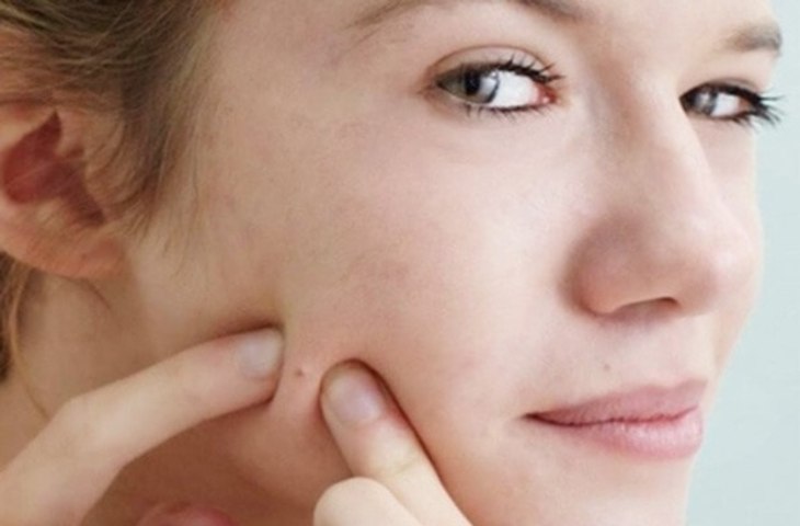Nặn mụn ẩn không đúng cách khiến da bị tổn thương gây viêm và để lại thâm sẹo