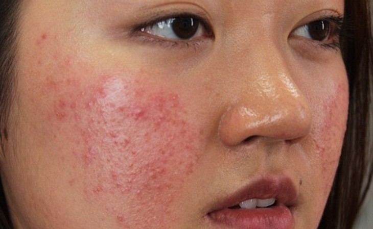 Mịn li ti hình thành có thể do dầu thừa, bã nhờn và bụi bẩn tích tụ trên da mặt