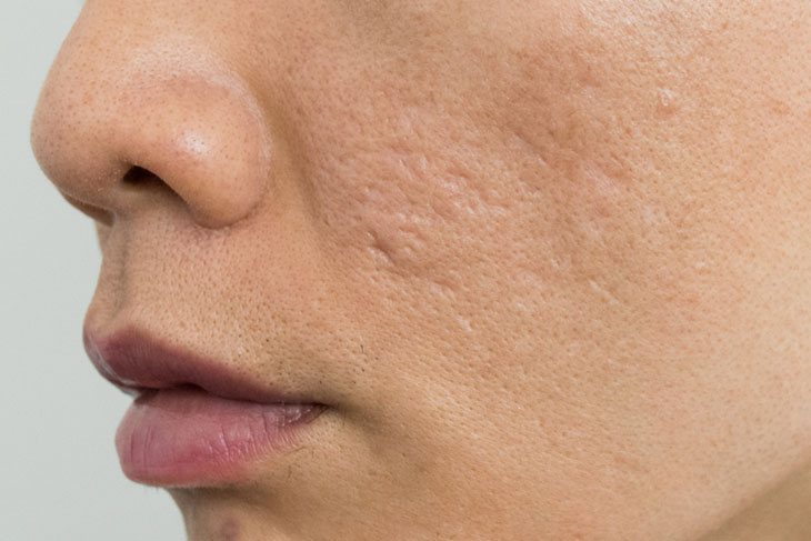 Nặn mụn ẩn sai cách có thể để lại sẹo rỗ vĩnh viễn trên da