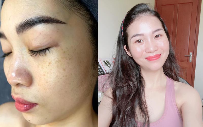 Làn da của chị Trang trước và sau khi sử dụng giải pháp từ YHCT