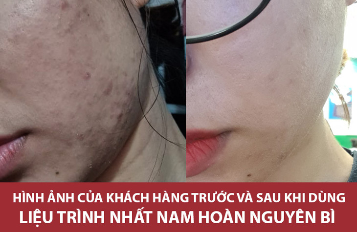 Làn da của chị Phương Thùy trước và sau khi điều trị mụn mủ với Nhất Nam Hoàn Nguyên Bì