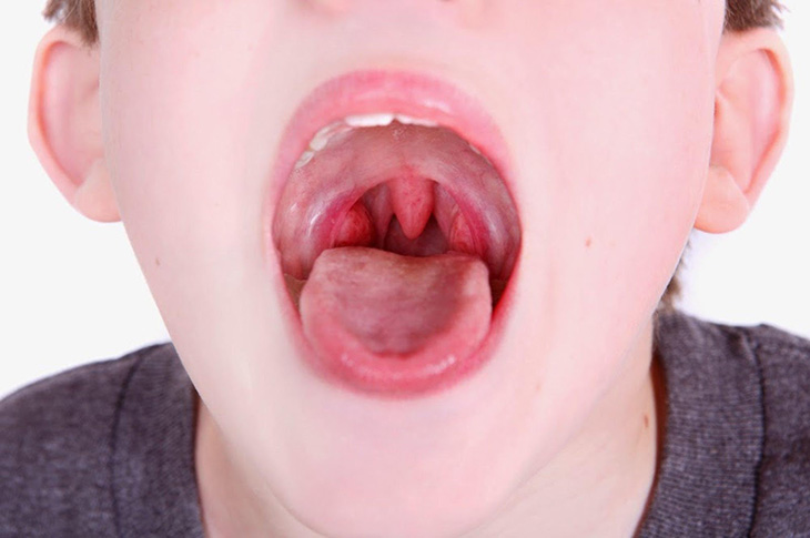Viêm mũi họng cấp ở trẻ em là tình trạng có liên quan đến đường hô hấp trên