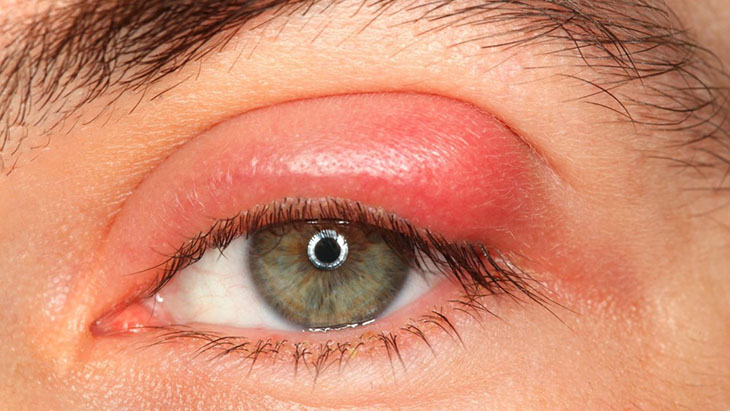 Bạn có thể gặp phải biến chứng áp xe mí mắt nếu không chữa kịp thời