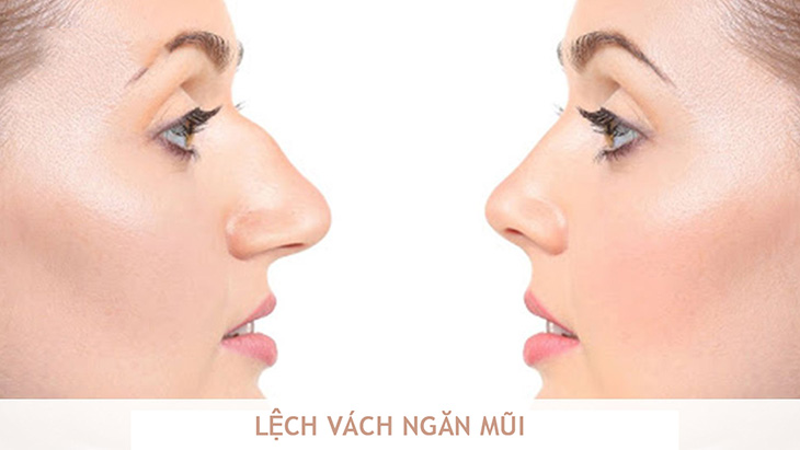 Lệch vách ngăn mũi hoặc phì đại cuống mũi là 2 biến chứng viêm xoang phổ biến