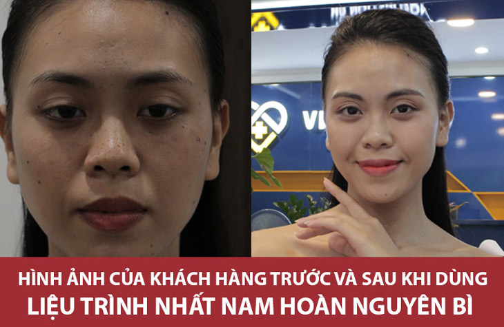 Làn da của chị Trang trước và sau khi dùng Nhất Nam Hoàn Nguyên Bì đã có những thay đổi vô cùng tích cực