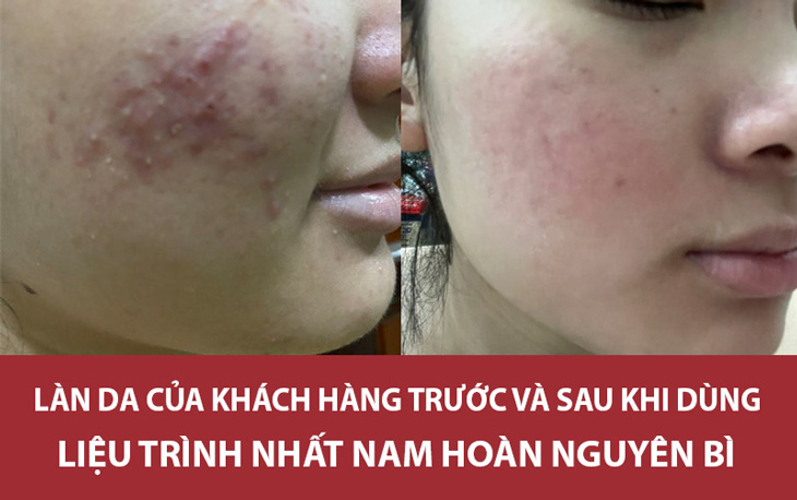 Làn da của khách hàng Hoài Phương cũng có những chuyển biến tích cực sau khi dùng thuốc Nhất Nam Hoàn Nguyên Bì