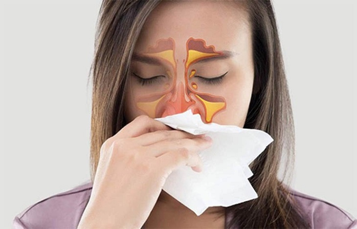 Viêm xoang có nguy cơ hình thành nên Polyp mũi nếu không được điều trị kịp thời