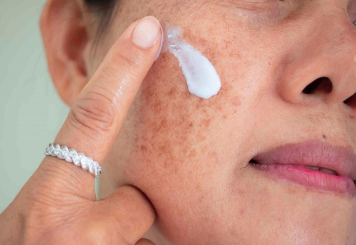 Sau khi sử dụng thuốc trị nám da mặt thì cần tránh tia UV ngoài trời
