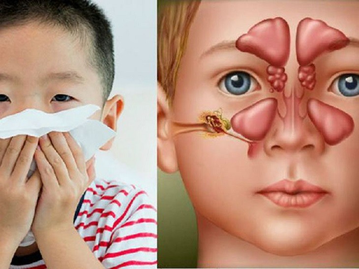 Bệnh gây ra những triệu chứng khó chịu như ngạt mũi, khó thở, ho, sốt...
